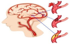 AVC – Sintomas de Alerta