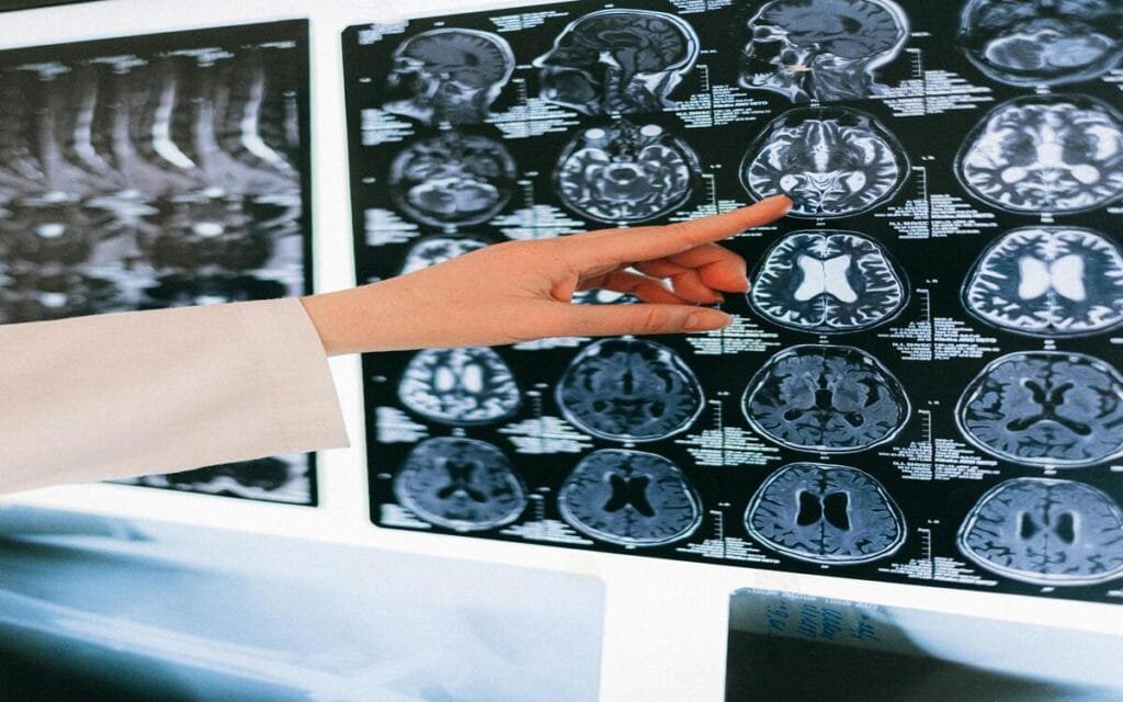 AVC – Sintomas de Alerta