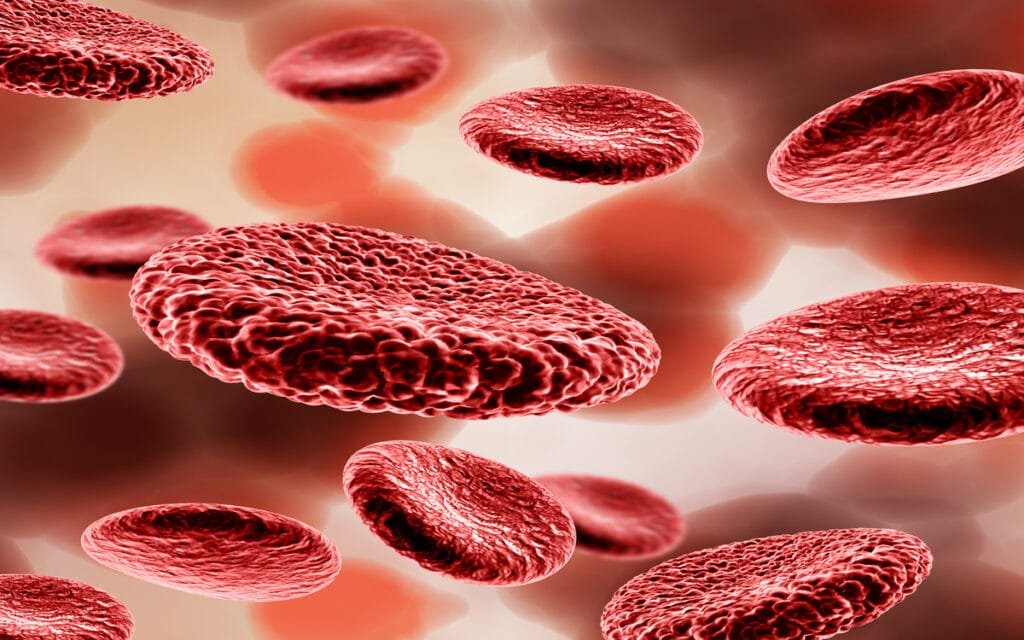 anemia